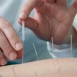How Effective Is Acupuncture for Depression?