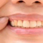 Simple Home Remedies for Cold Sores in Mouth