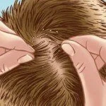 Natural Treatment for Head Lice
