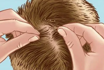 head-lice-treatment